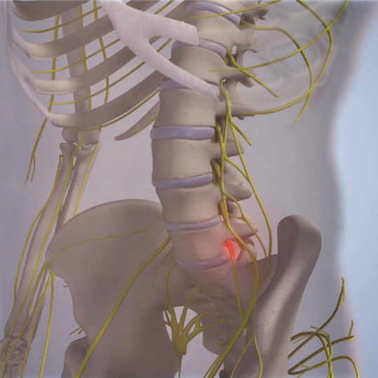 Le Bombement Discal - Solution Clinique Tagmed Montréal Terrebonne