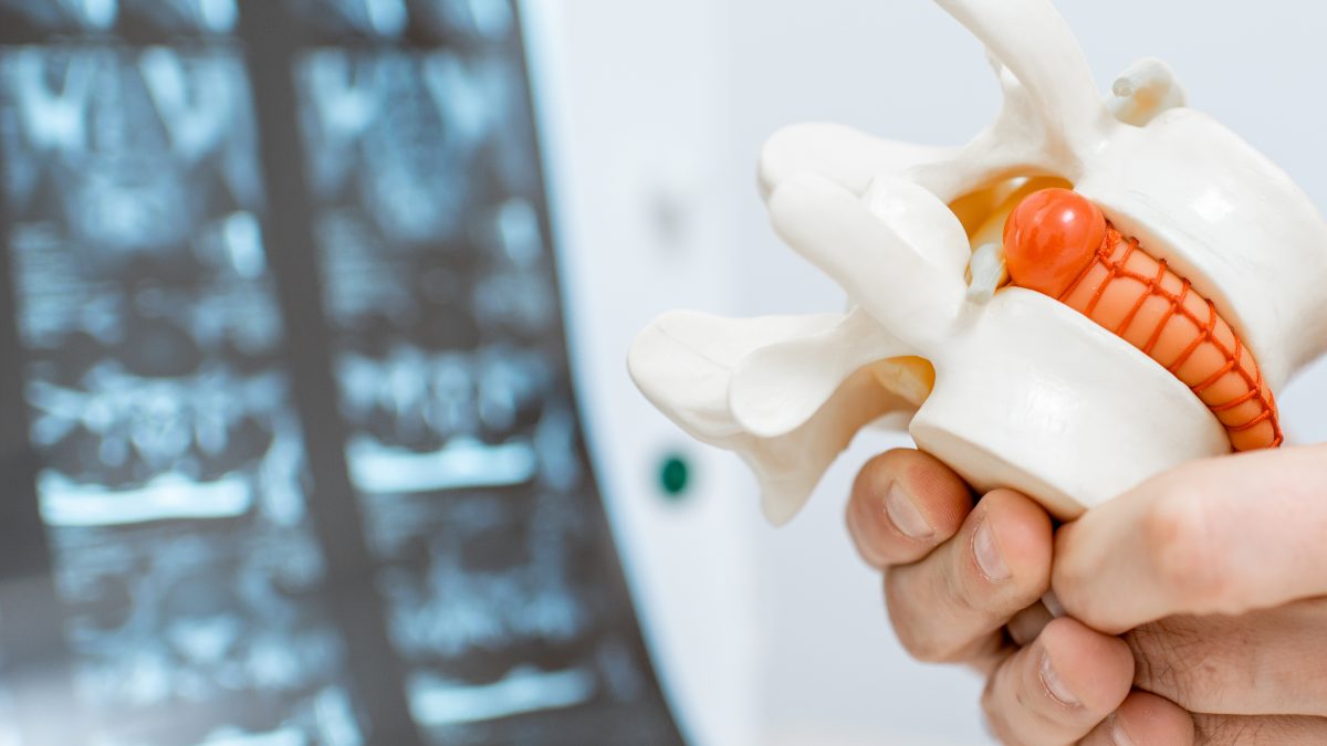 Hernie Discale : Comprendre Les Causes Et Les Options De Traitement Disponibles Clinique Tagmed Montréal Terrebonne