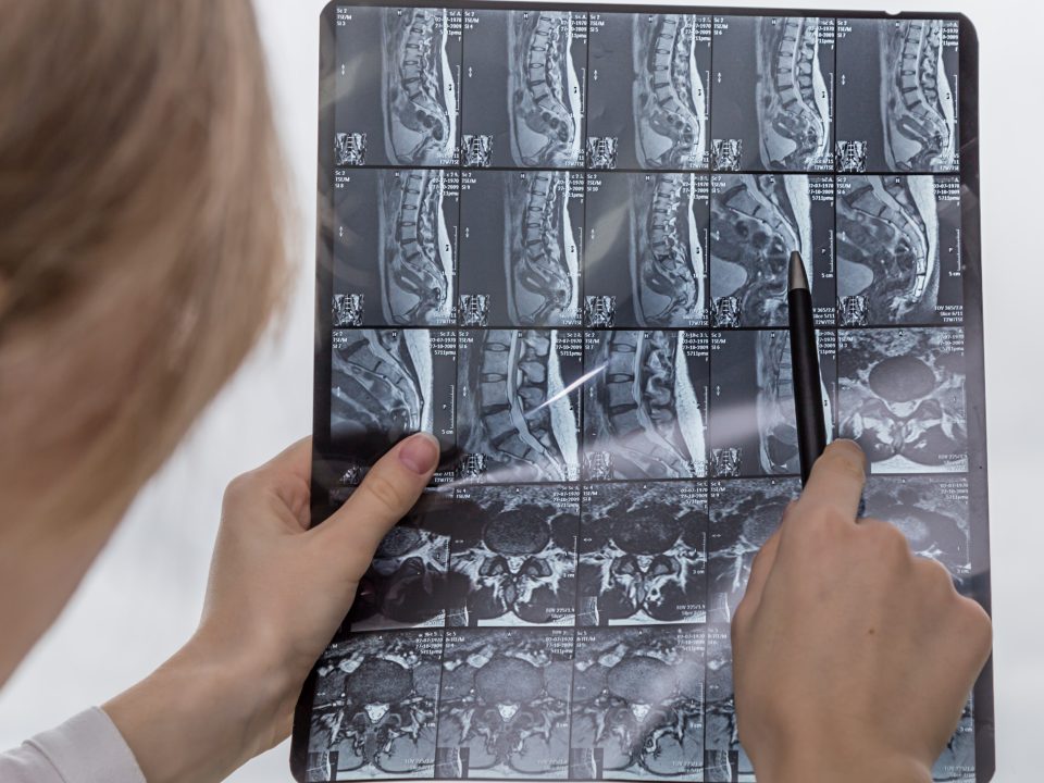 Sténose Spinale Clinique Tagmed Montréal Terrebonne