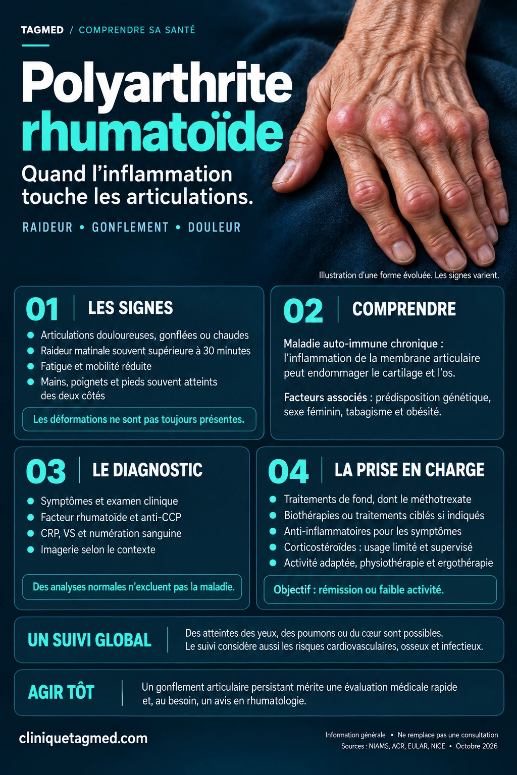 Polyarthrite Rhumatoïde : Symptômes, Diagnostic Et Traitements 5 Affiche Sur La Polyarthrite Rhumatoïde Montrant Des Articulations Des Doigts Gonflées Et Une Déviation Des Doigts Dans Une Forme Établie.